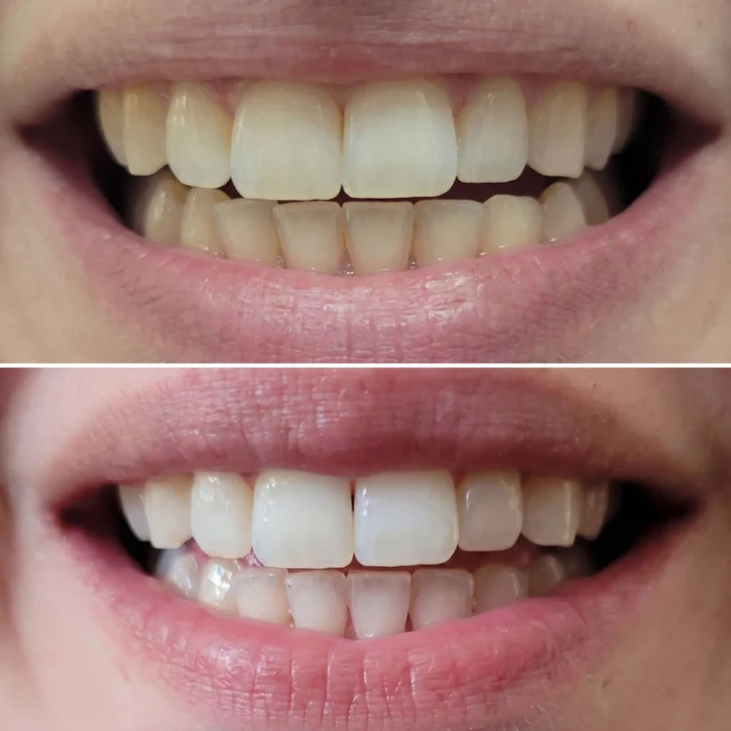 SHYNE® Diamond Series Teeth Whitening Kit | Professional Whitening at Home (3 Serums)