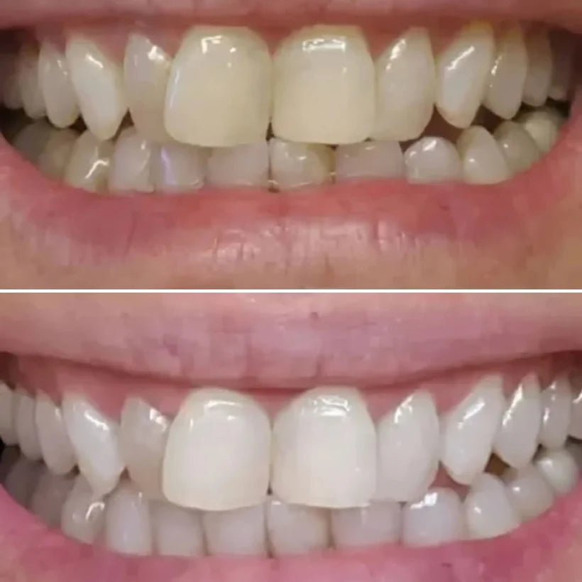 SHYNE® Diamond Series Teeth Whitening Kit | Professional Whitening at Home (3 Serums)