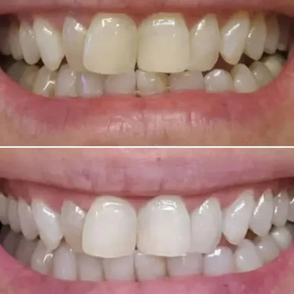 SHYNE® Diamond Series Teeth Whitening Kit | Professional Whitening at Home (3 Serums)
