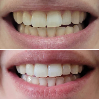 SHYNE® Diamond Series Teeth Whitening Kit | Professional Whitening at Home (3 Serums)
