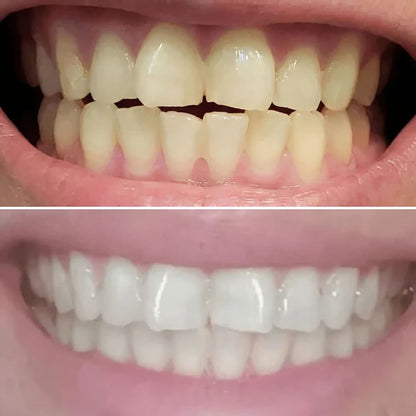 SHYNE® Diamond Series Teeth Whitening Kit | Professional Whitening at Home (3 Serums)