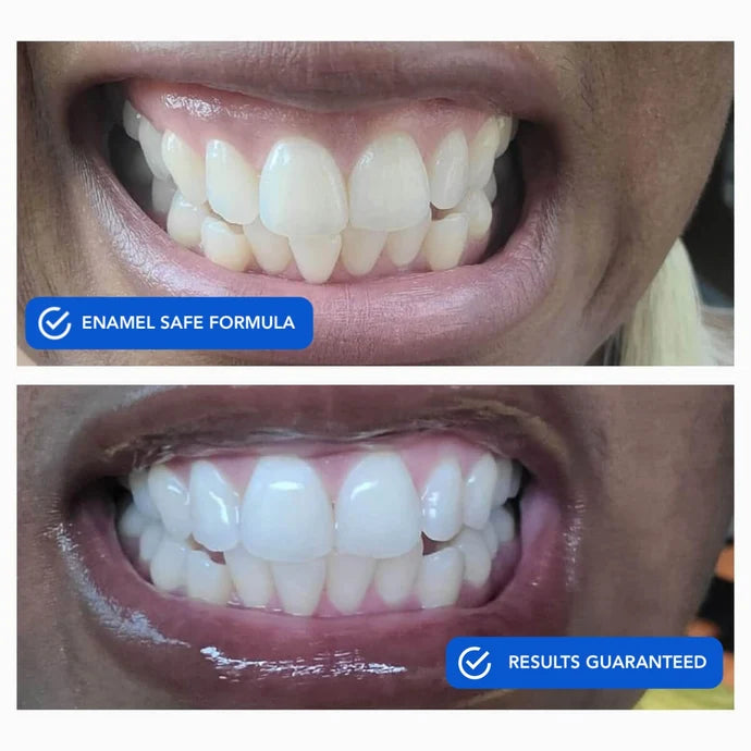 SHYNE® DiamondSeries® | Dissolving Teeth Whitening Strips